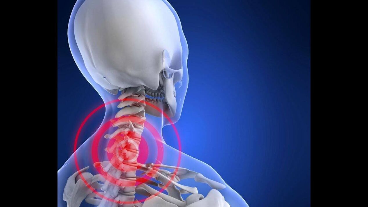 Osteochondróza krčnej chrbtice