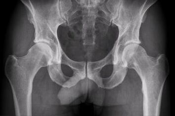 Diagnostické možnosti artrózy bedrového kĺbu