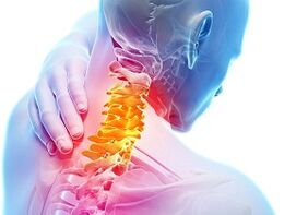 Hlavné príznaky a príznaky krčnej osteochondrózy