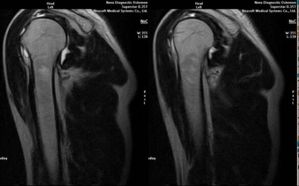 röntgen na diagnostiku artrózy ramena