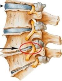 osteochondróza krčnej chrbtice