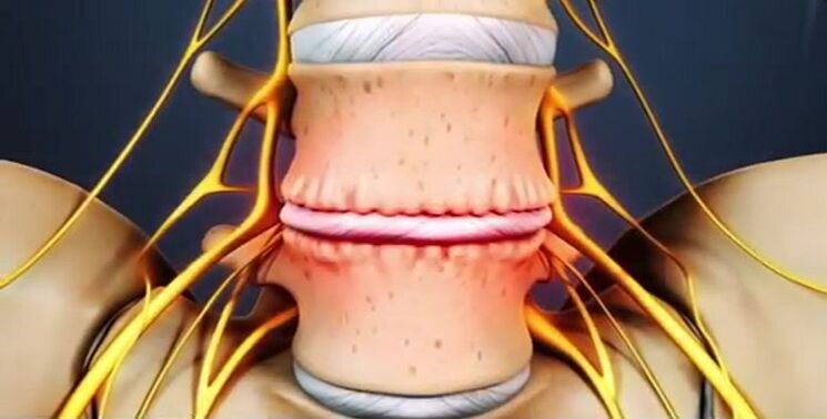 lézie chrbtice v dôsledku osteochondrózy